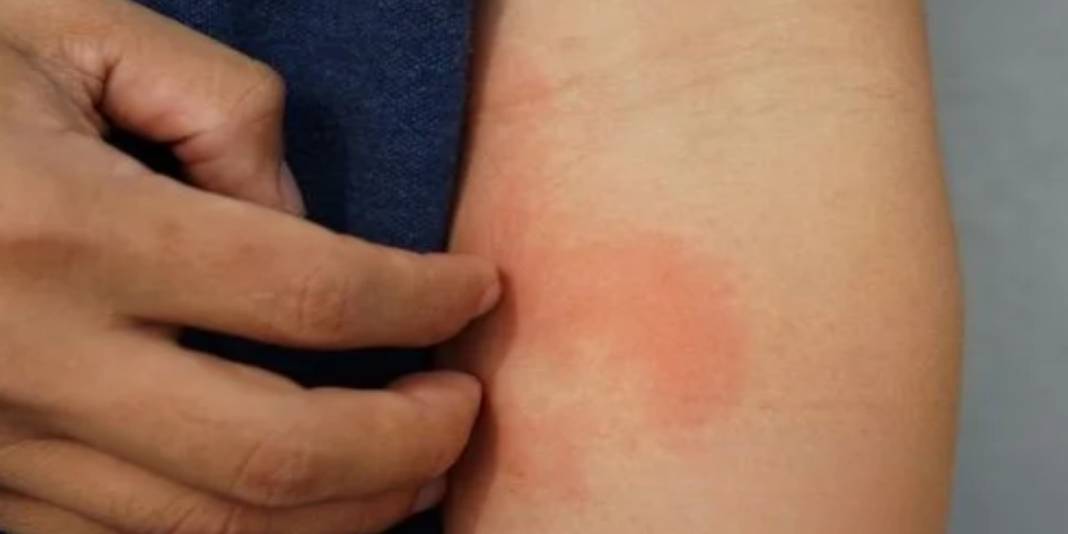 Yaz dönemi arttı: Bunu yapanlar alerji riski altında 5