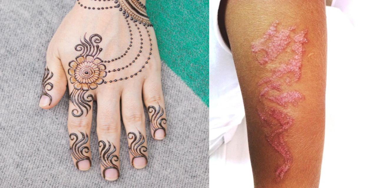 Yaz dönemi arttı: Bunu yapanlar alerji riski altında