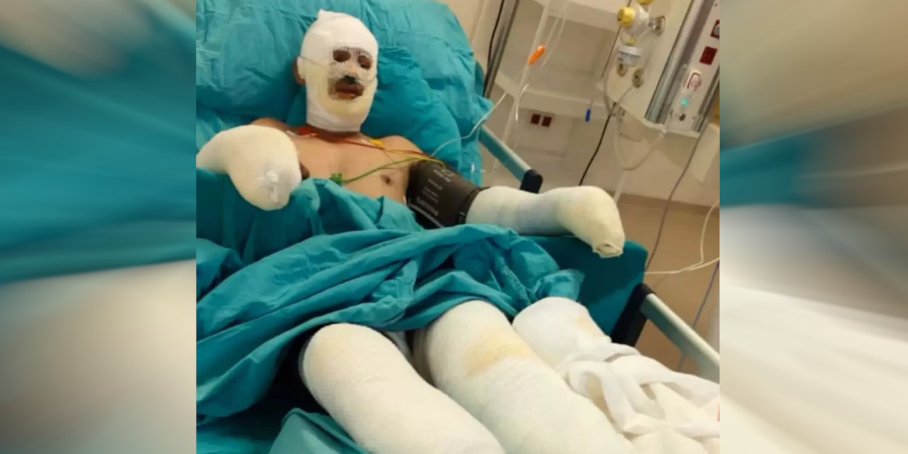 Orman yangınına müdahalede ağır yaralanan işçinin son hali