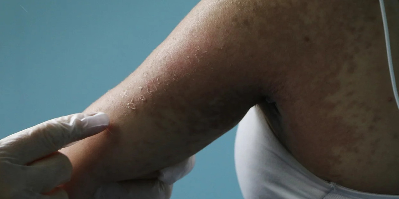 İnternetten sipariş ettiği krem yüzünden acillik oldu