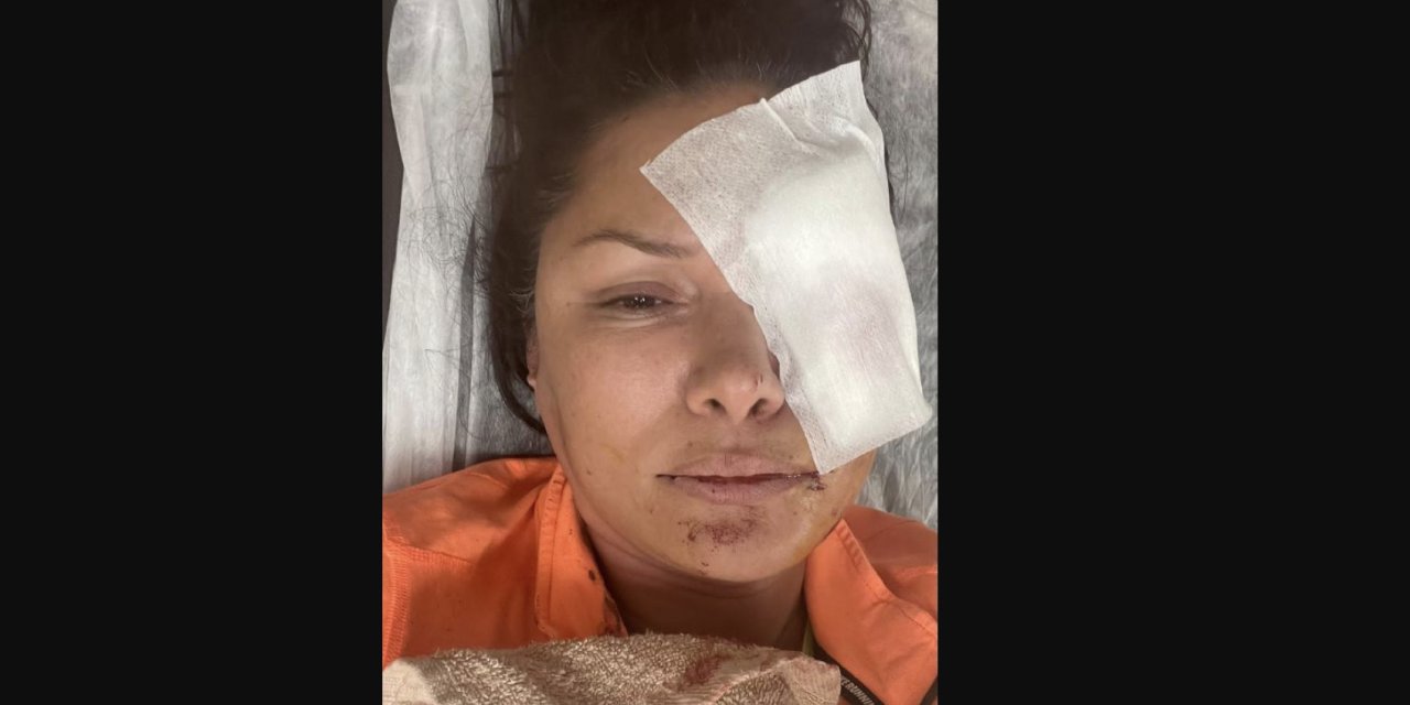 Şarkıcı Tuğba Altıntop bir köpeğin saldırısına uğradı, yüzüne dikiş atıldı
