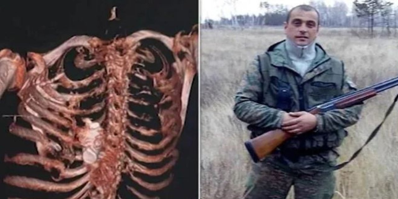 Tıp dünyasını şaşırtan olay! Patlamamış el bombası Rus askerin göğüs kafesine sıkıştı