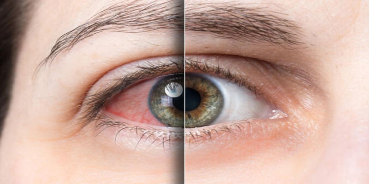 Mevsimsel alerjiler, en çok gözleri etkiliyor