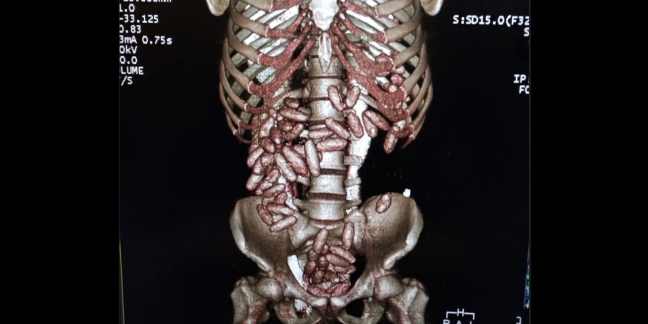 Uyuşturucu yutarak kuryelik yapan yolcu tomografiden kaçamadı