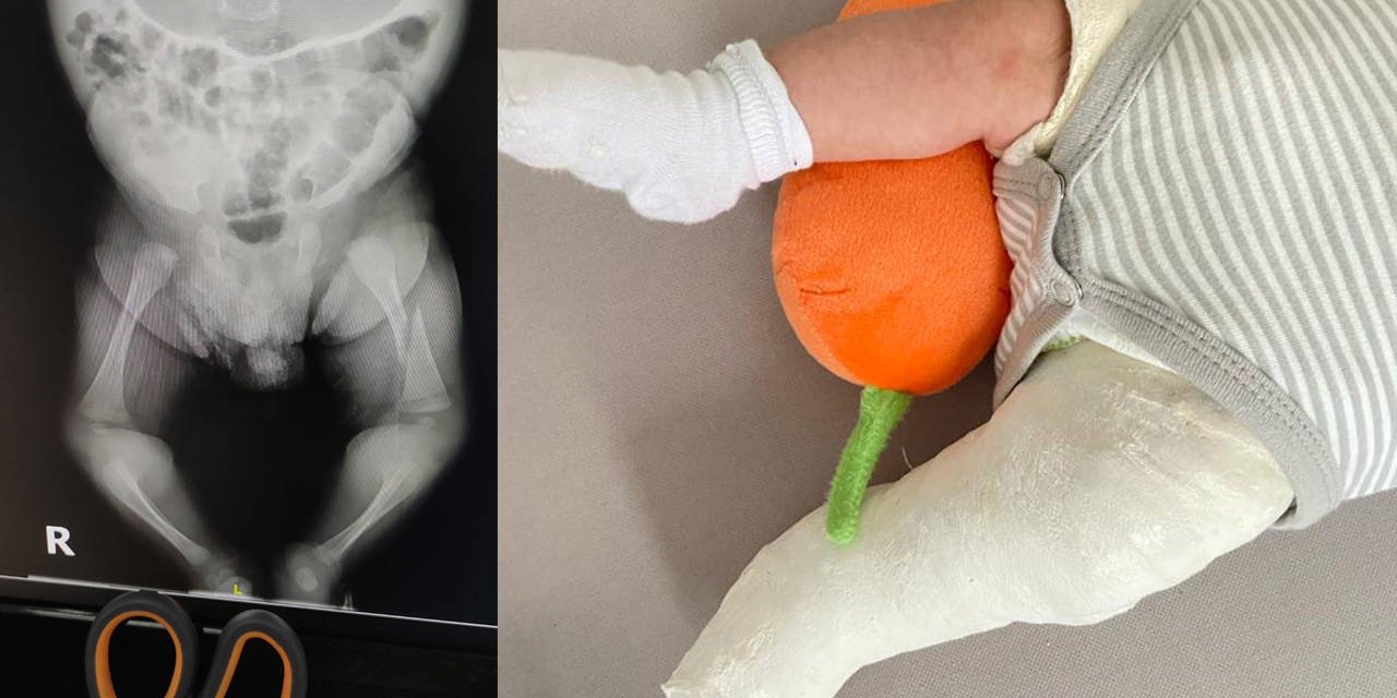 Eski AKP'li vekilin ortağı olduğu hastanede bir aylık bebeğin bacağı kırıldı: Bakanlık soruşturma izni vermedi