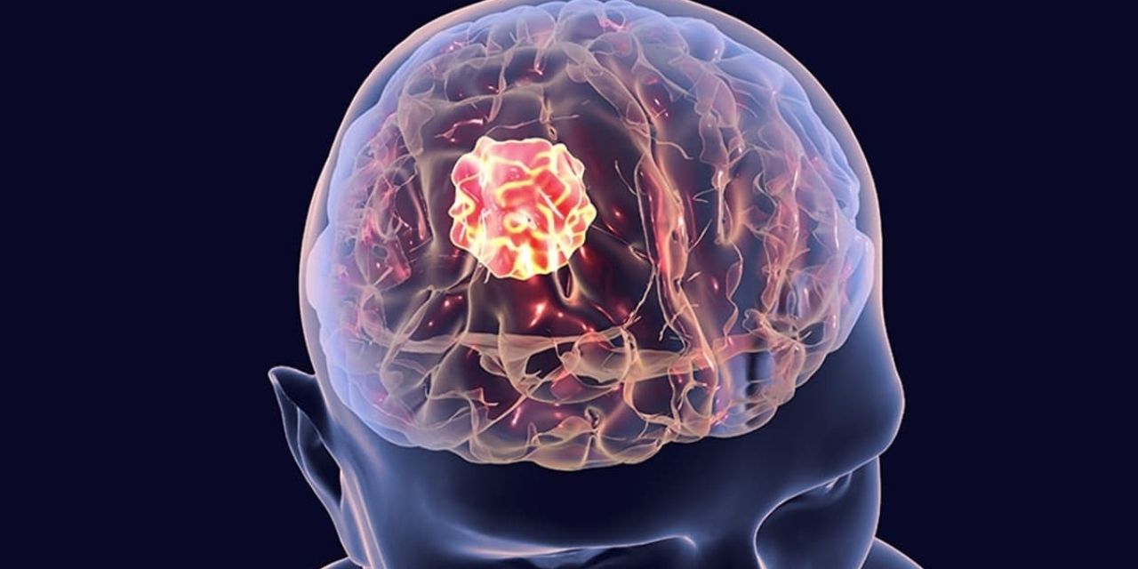 Beyin kanseri tedavisinde gelişme: Kan testi ile erken teşhis edilebilecek