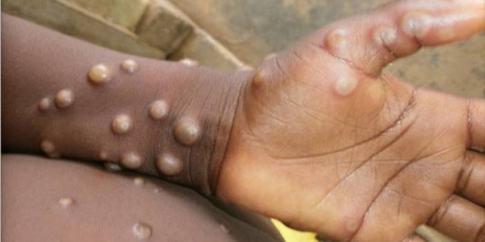 Salgın yayılıyor: Maymun çiçeği virüsü Avrupa'da iki ülkeye daha sıçradı