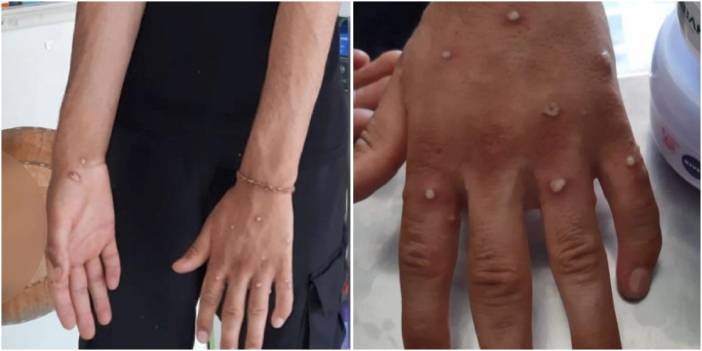 Asya'da maymun çiçeğinden ilk ölüm