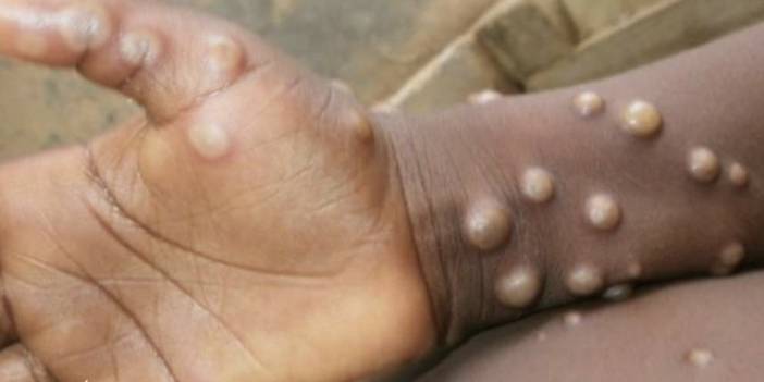 Maymun çiçeği virüsü Türkiye'de