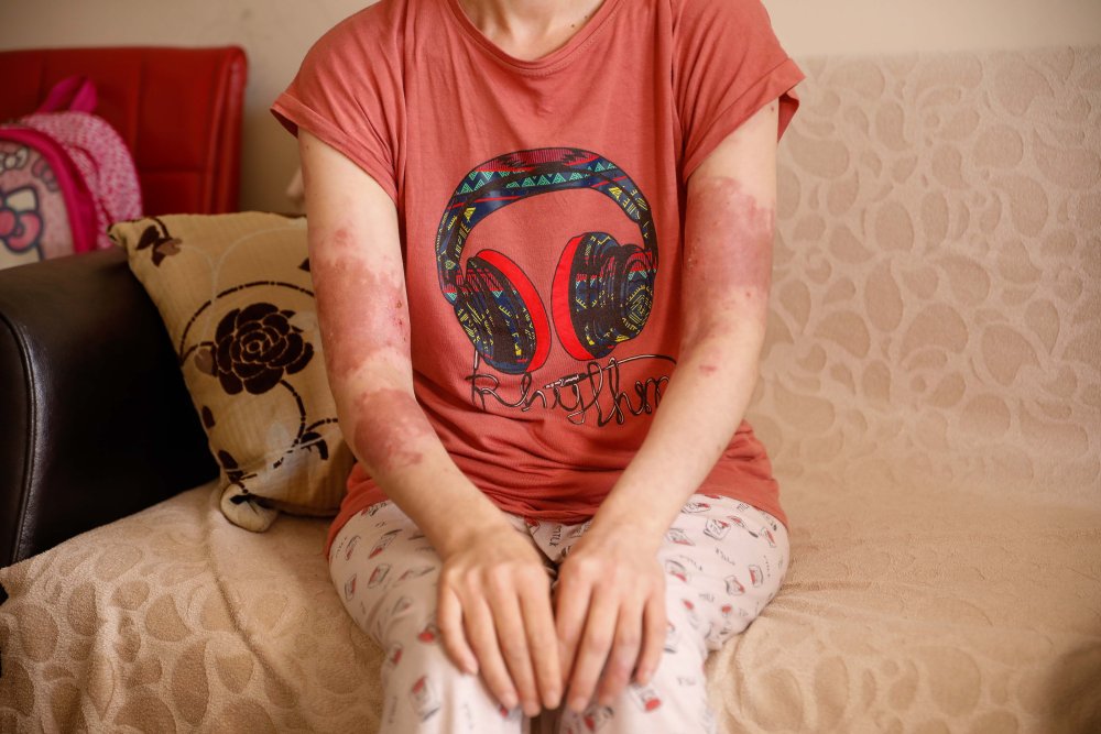 Eski eltisi 17 kez bıçaklayıp, üzerine kaynar su döktü