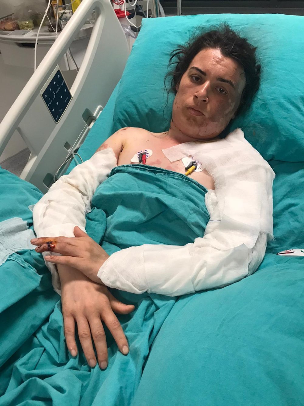 Eski eltisi 17 kez bıçaklayıp, üzerine kaynar su döktü