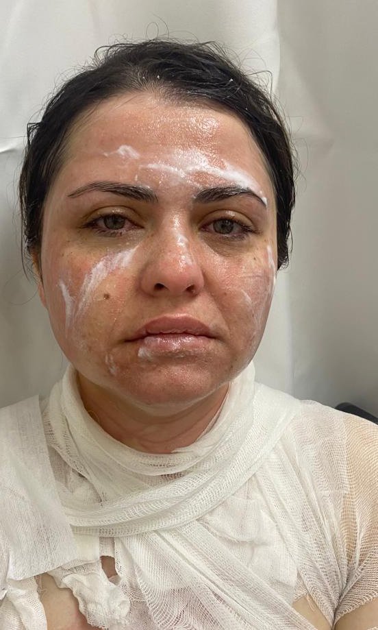 Savcının odasından kovulmuştu: Eski kocası yüzüne pas sökücü döktü